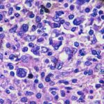 FDA Requires Boxed Warning for CAR-T Cell Therapies Due to Risk of Secondary Cancers