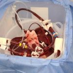 Groundbreaking Liver Transplant Uses Gene-Edited Pig Organ